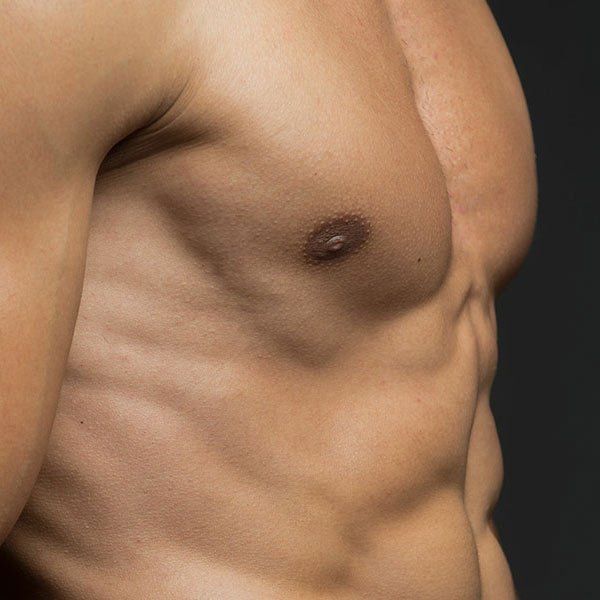 Best Gynecomastia Surgery, Male Breast Reduction Surgeon in India