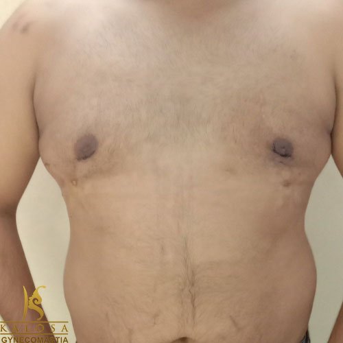 Gynecomastia Treatment for Man Boobs