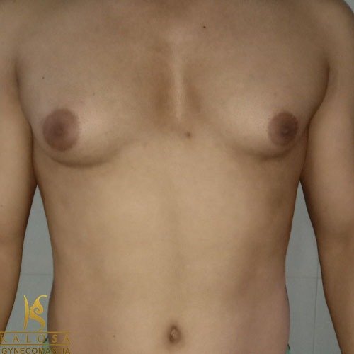 Gynecomastia Treatment for Man Boobs