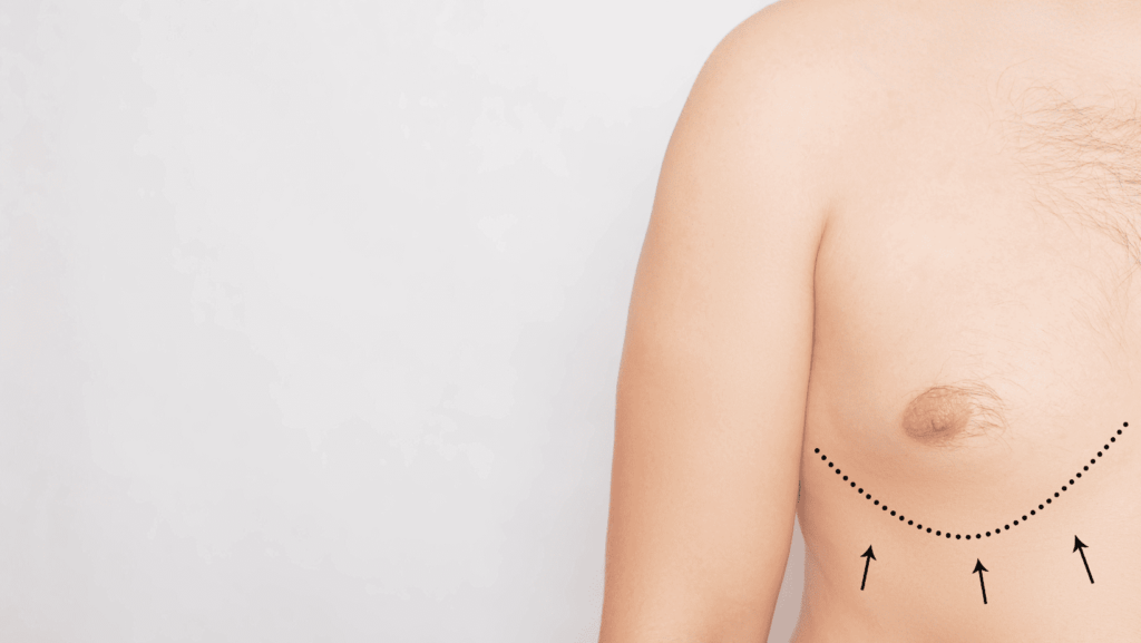 gynecomastia-surgery-in-male-breast-reduction